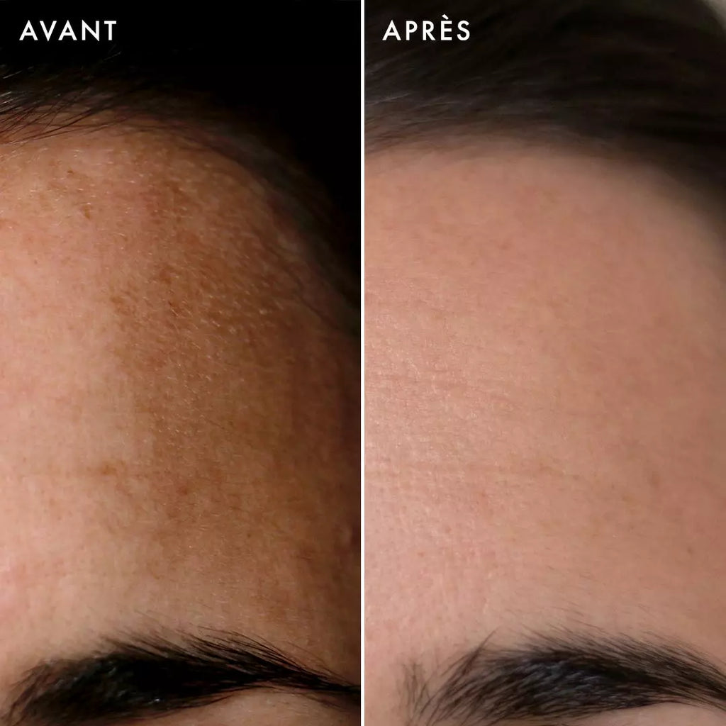 Hyperpigmentation
